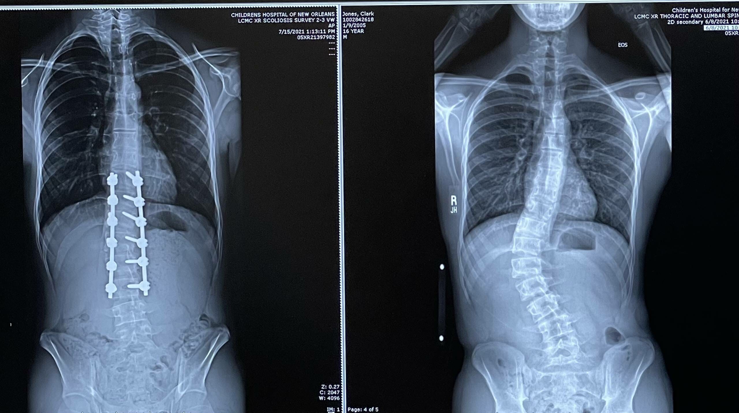 teen scoliosis before and after surgery