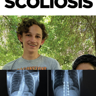 picture of teen boy and before and after x-rays of scoliosis